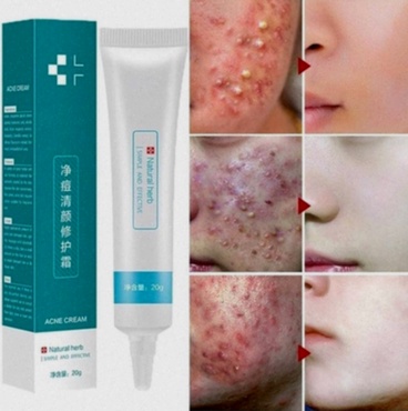 crème anti-acné générique