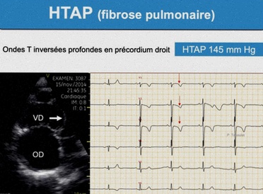 Traitement HTAP générique