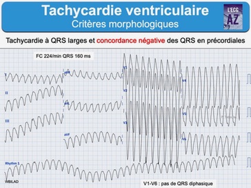 traitement arythmie pas cher