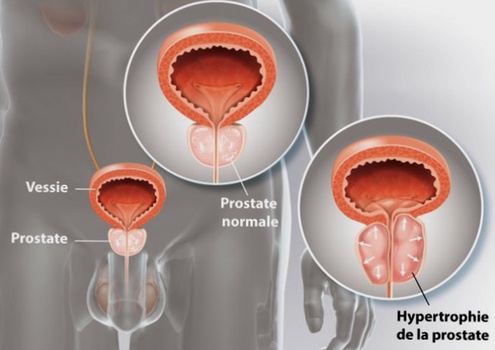 Traitement hypertrophie bénigne de la prostate générique